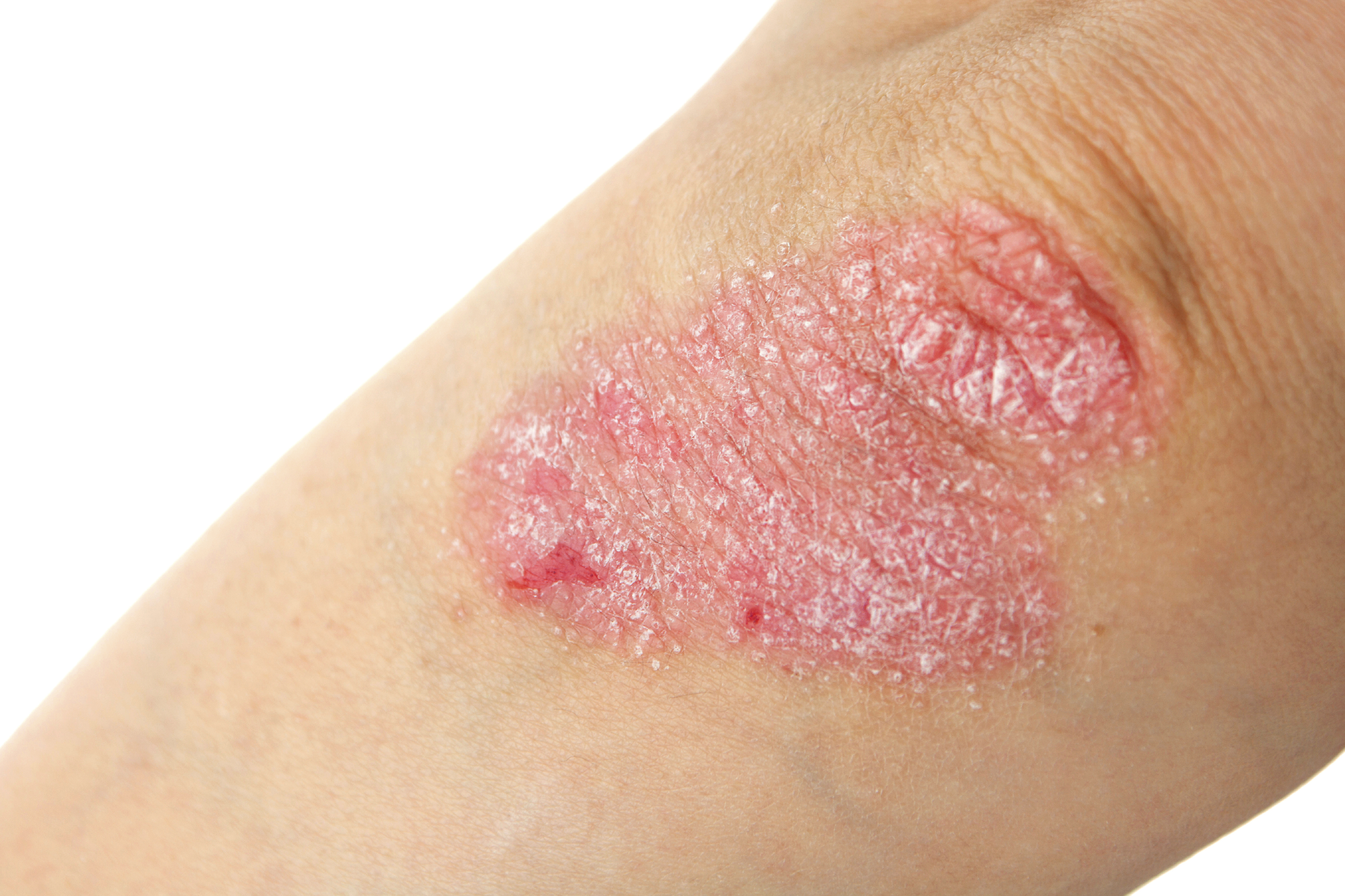 PSORIASIN®- A Treatment For Your Psoriasis? 
